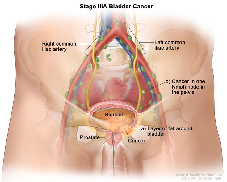 BLADDER CANCER